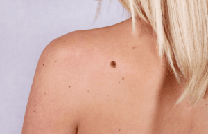 Lady with mole on her back